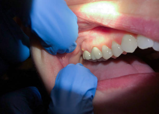 Best Emergency Denture Repair in East Port Orchard, WA